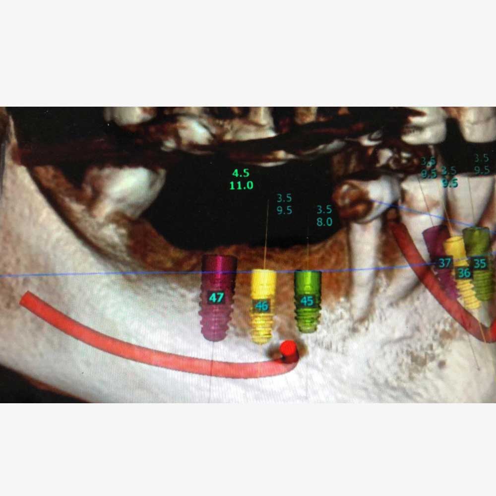 Dental Implants
