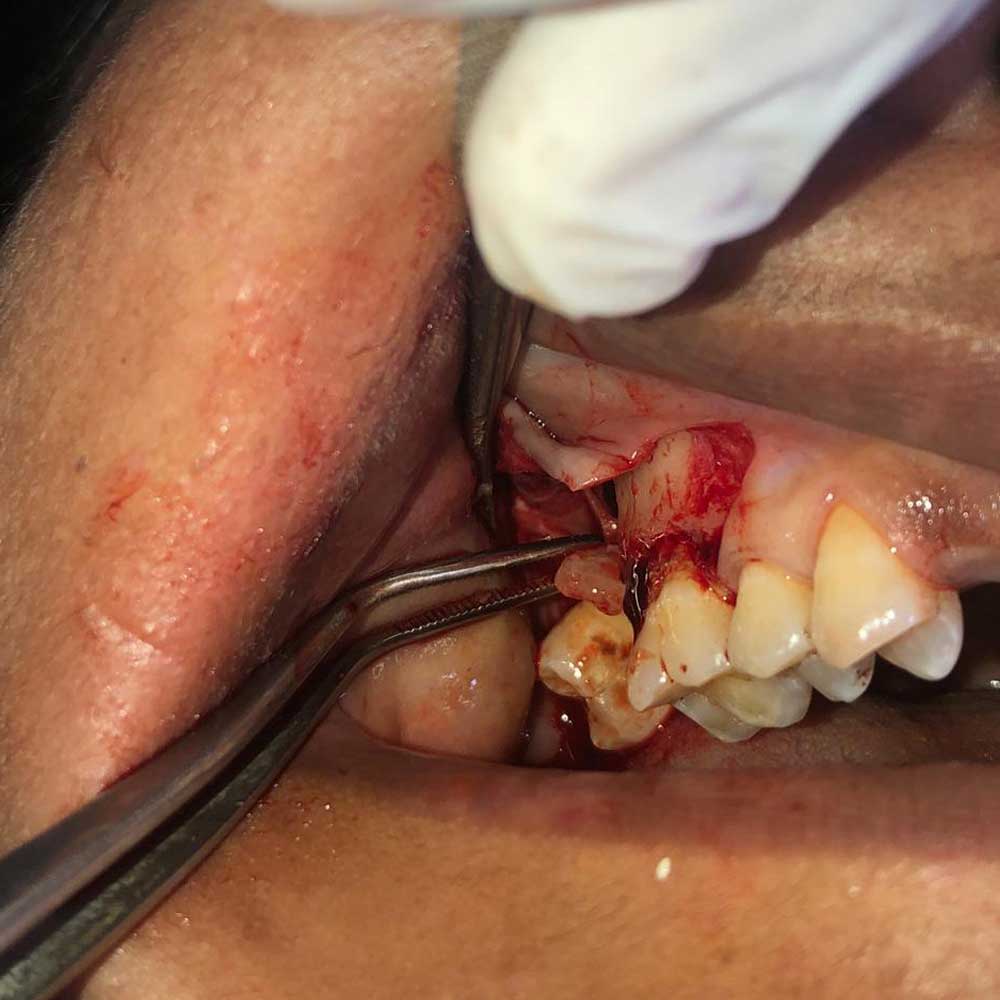Dental Implants