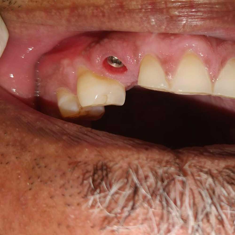 Dental Implants
