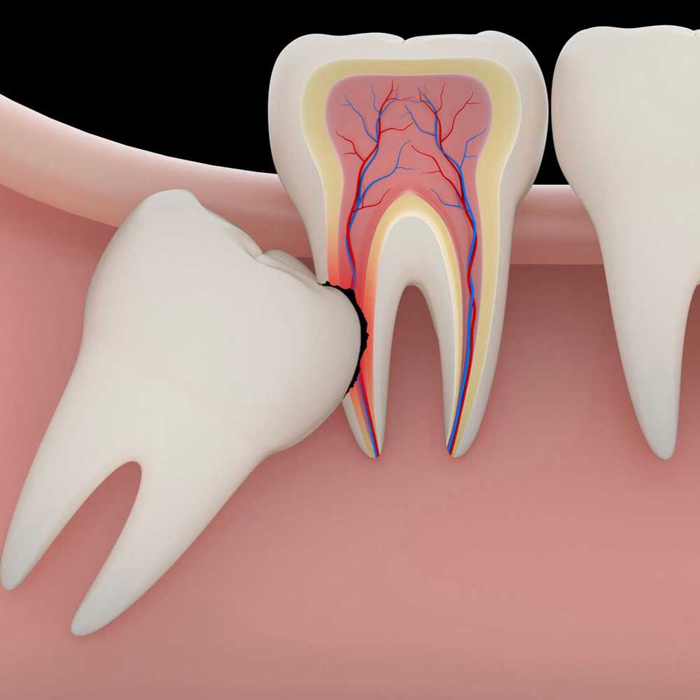 Wisdom Tooth