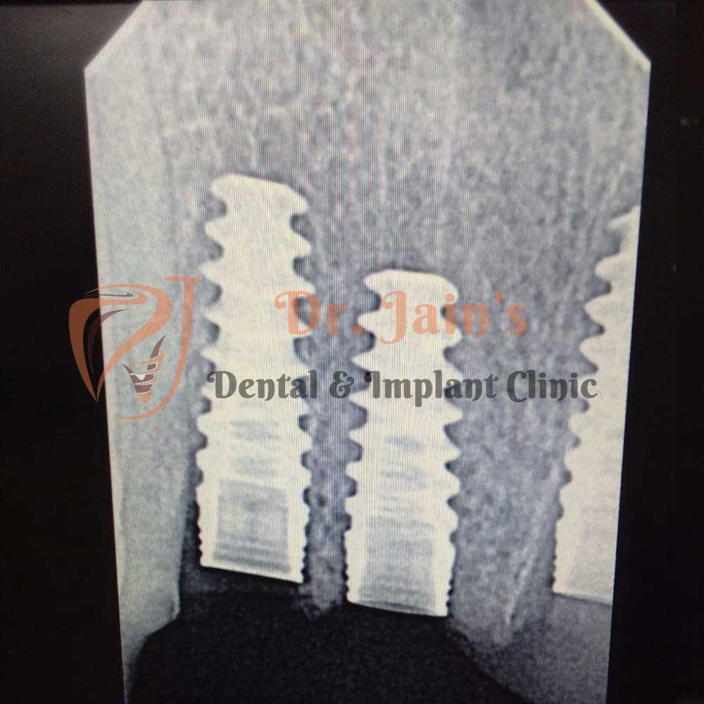 Dental Implants