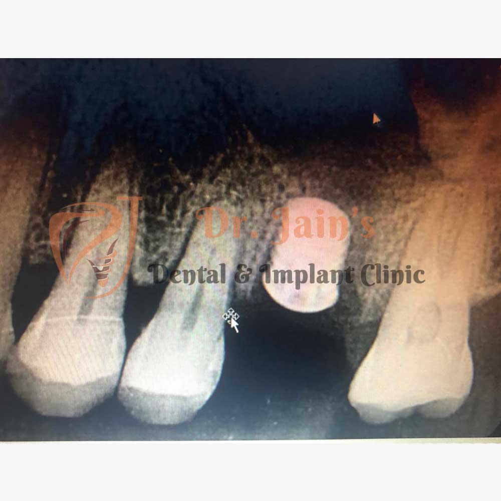 Dental Implants