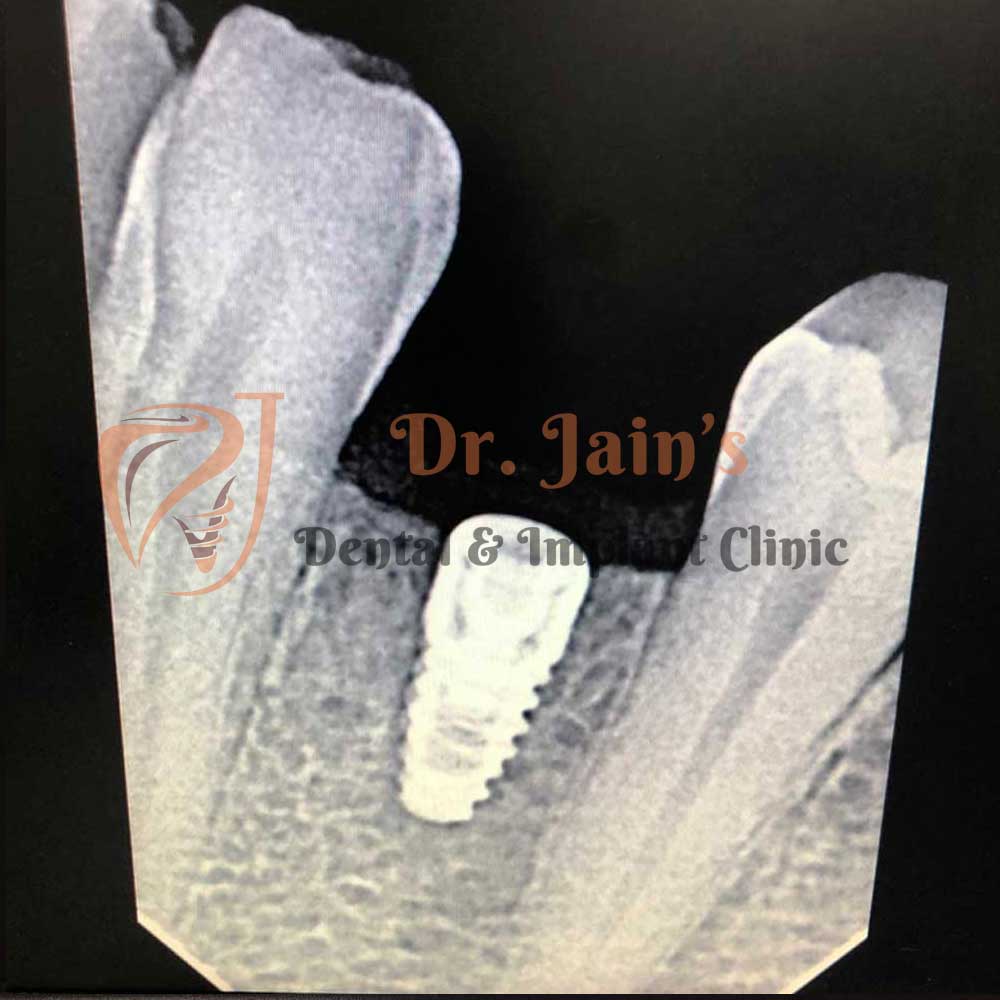 Dental Implants