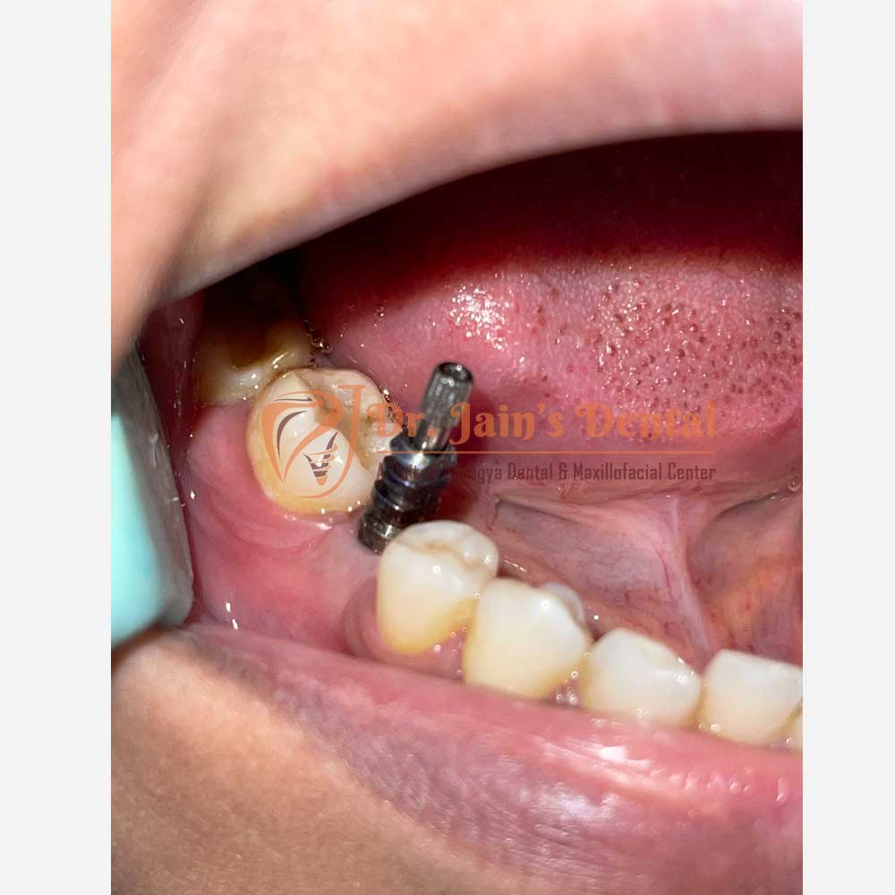Implant Crowns