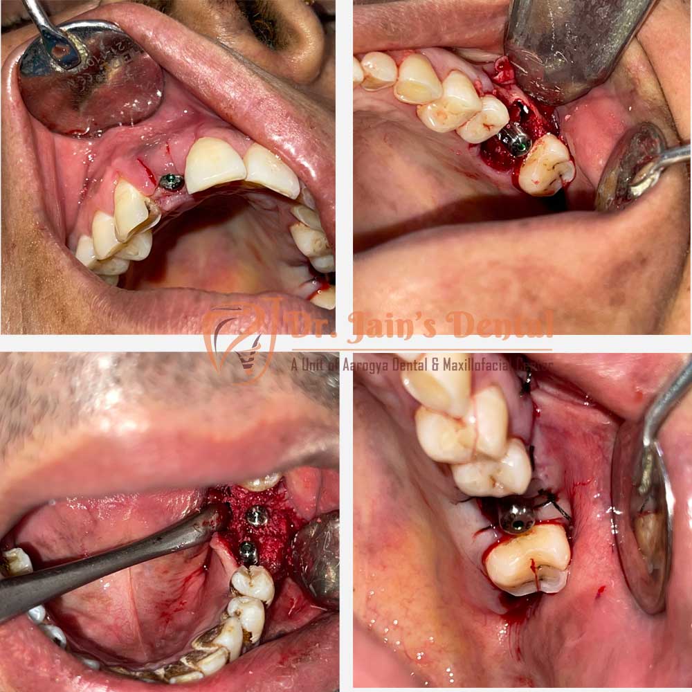 Immediate Dental Implants