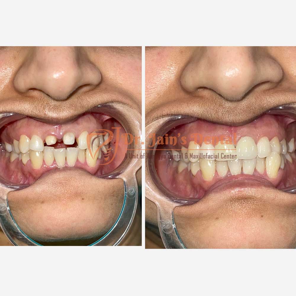 Immediate Implants & Metal Free Crowns