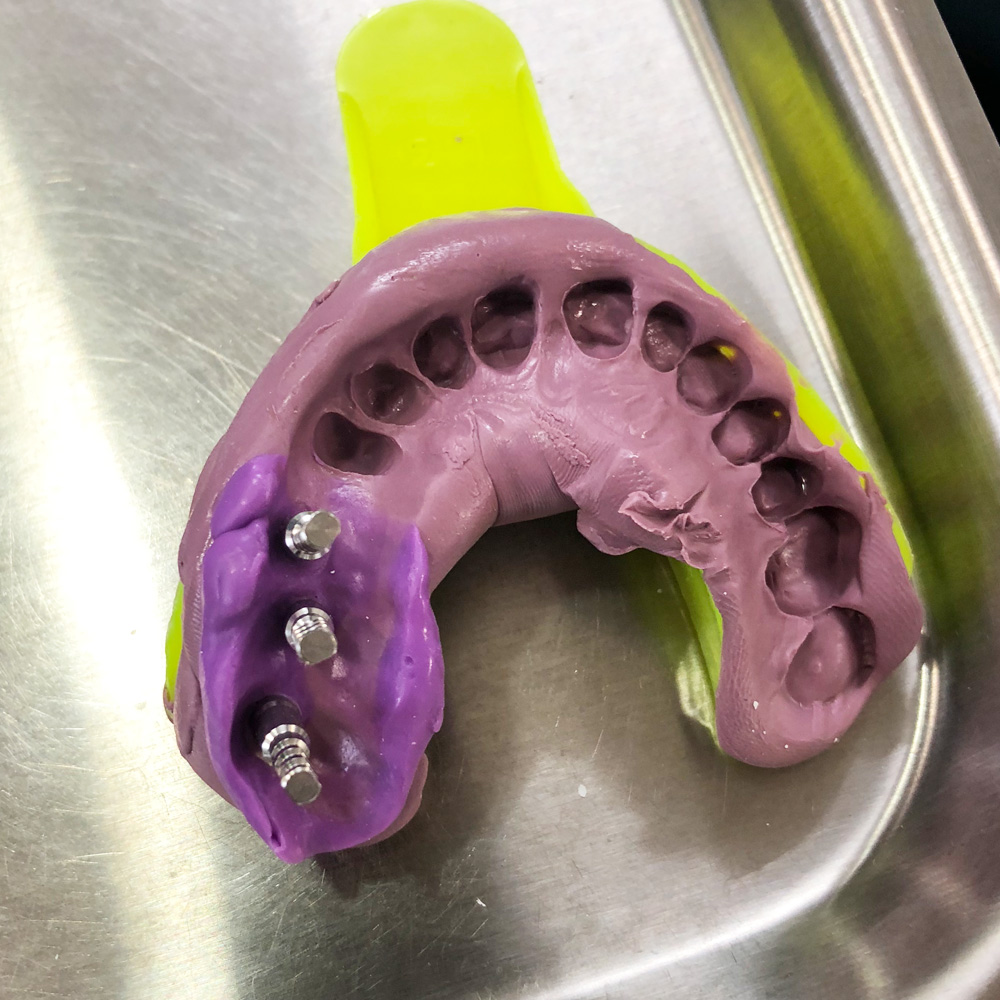 Dental Implants