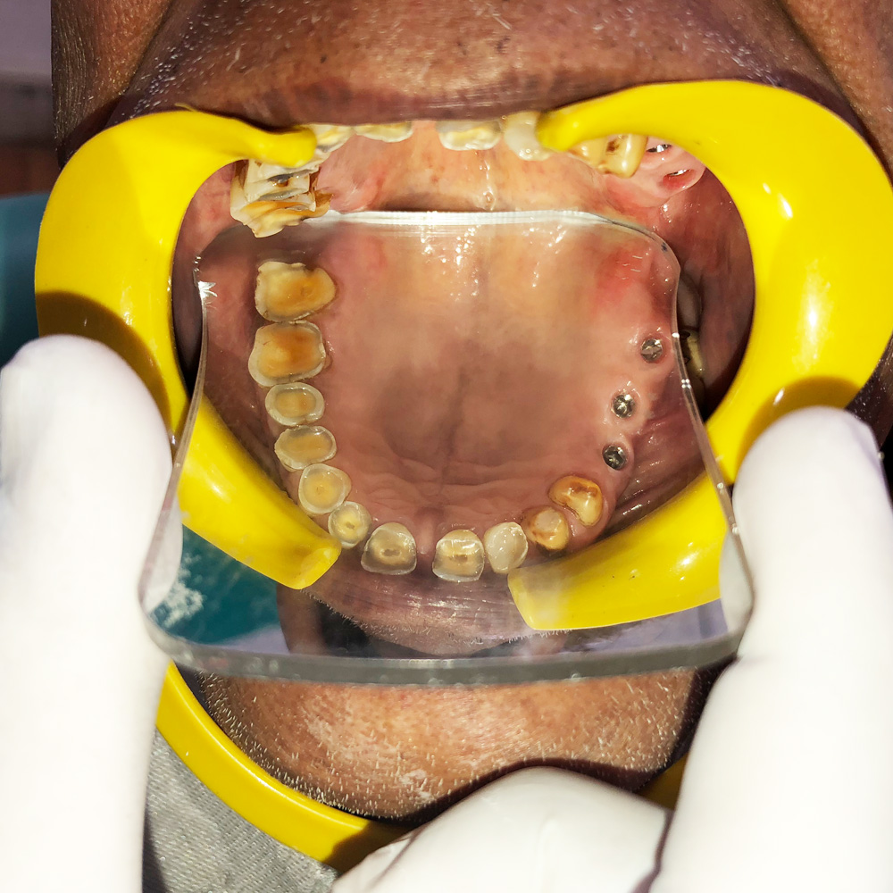 Dental Implants