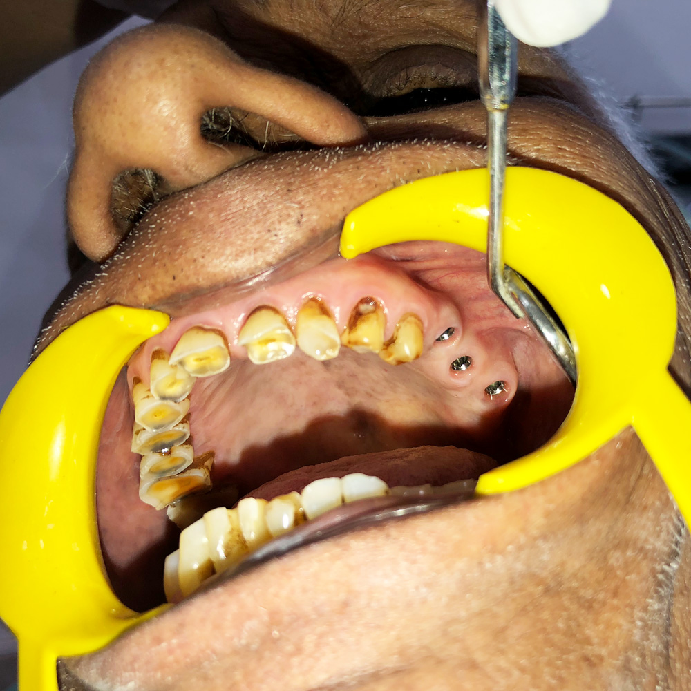 Dental Implants