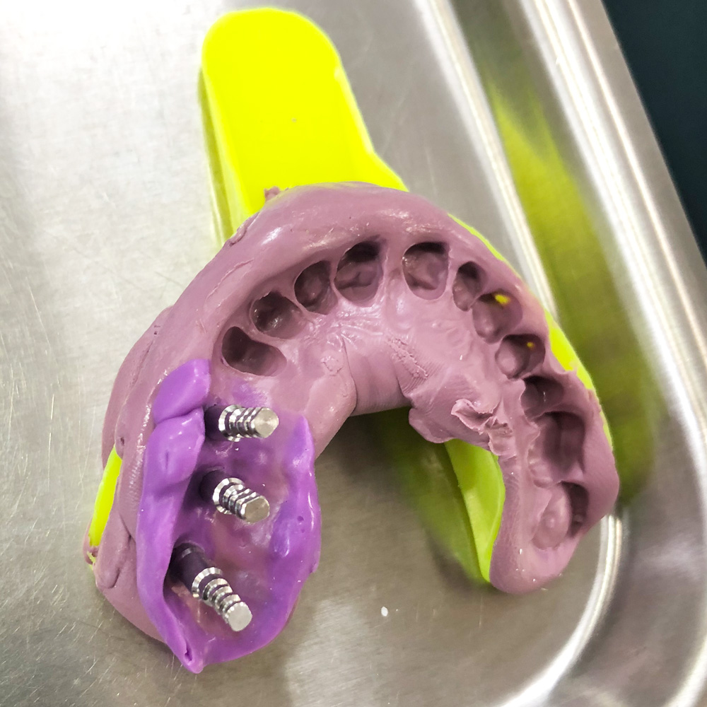 Dental Implants