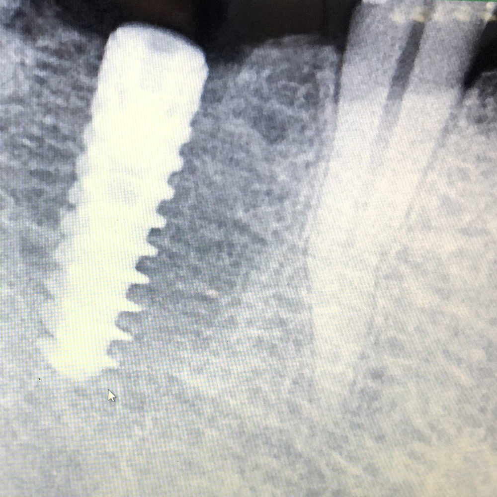Dental Single Tooth Implant