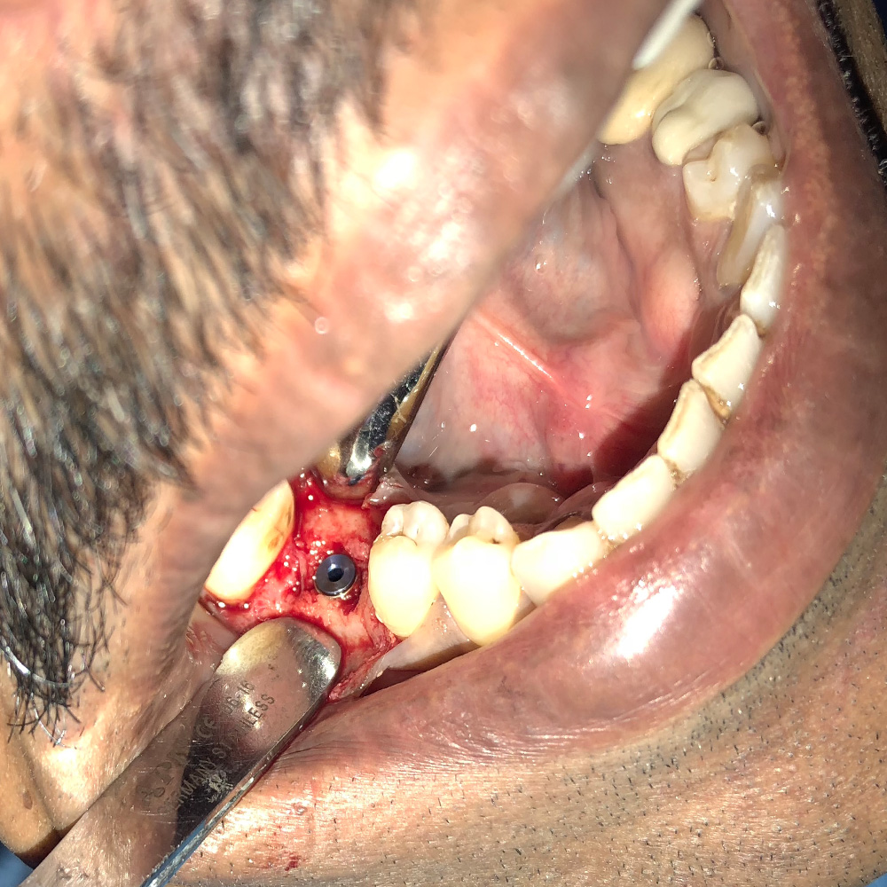 Dental Single Tooth Implant