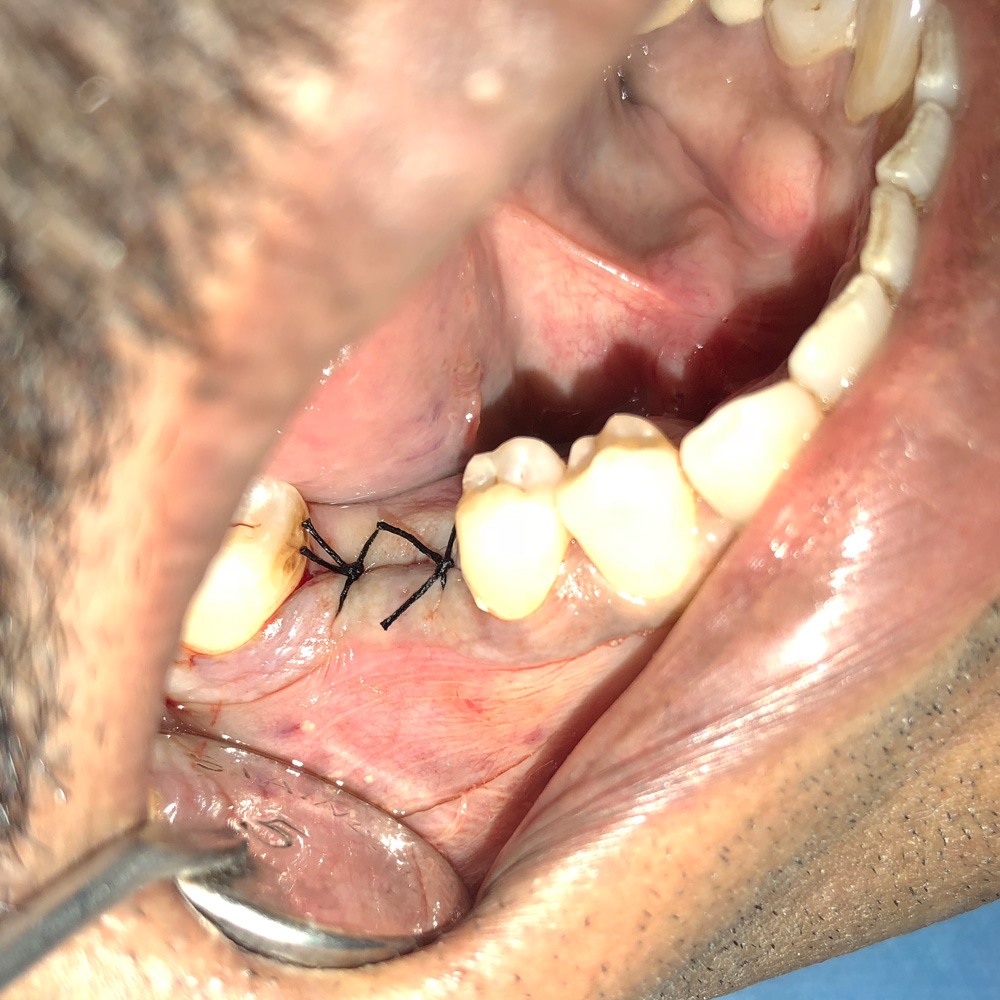 Dental Single Tooth Implant