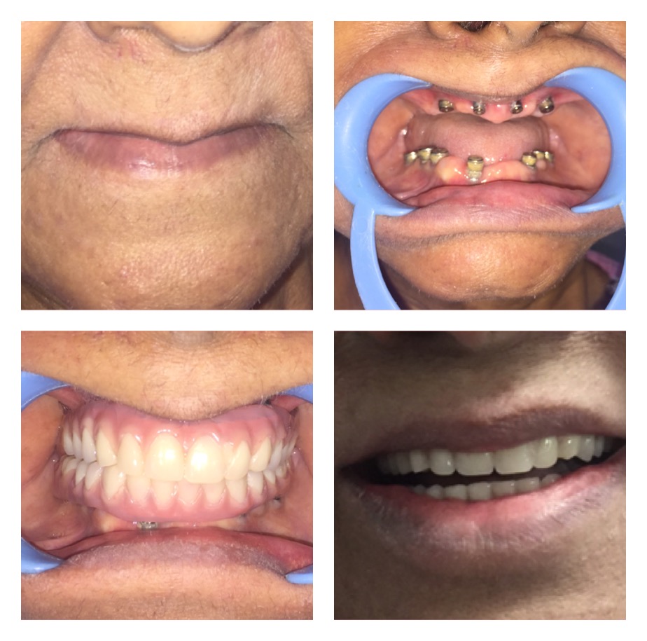 Full Mouth Implants
