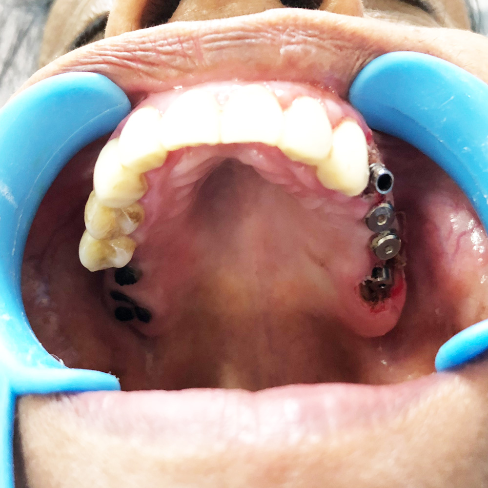 Full Arch&nbsp;Implants
