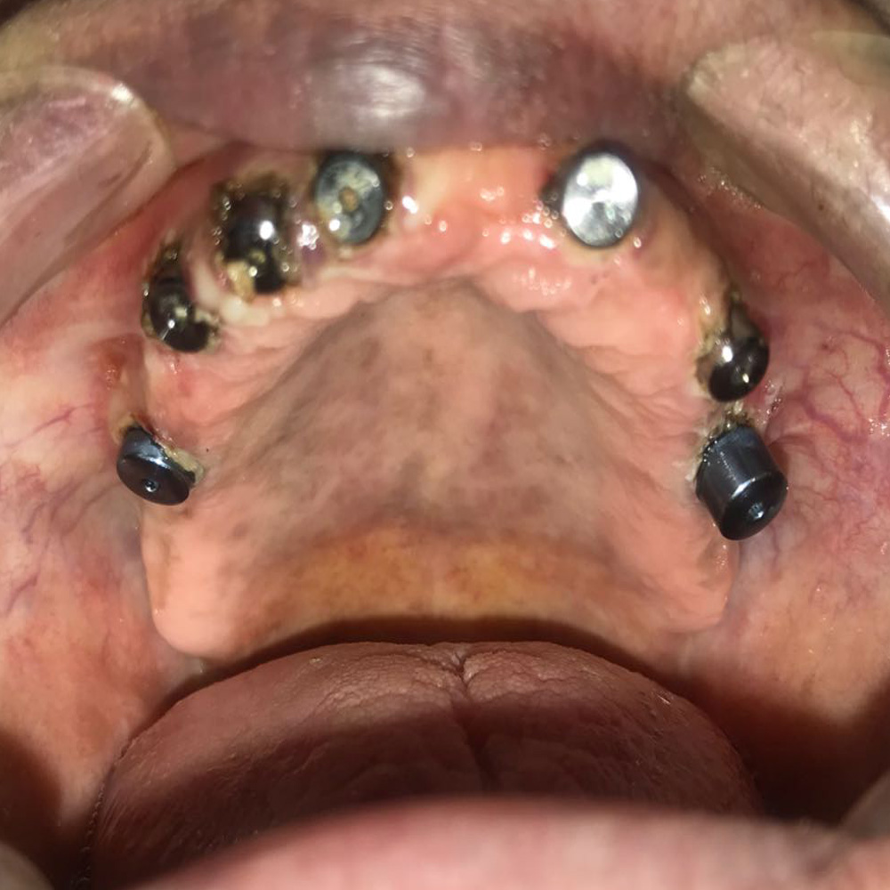 Full Arch&nbsp;Implants