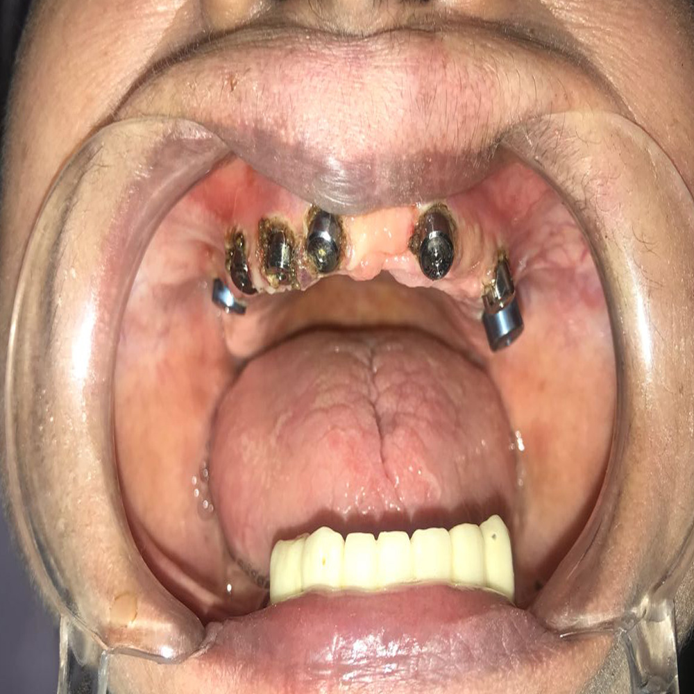 Full Arch&nbsp;Implants