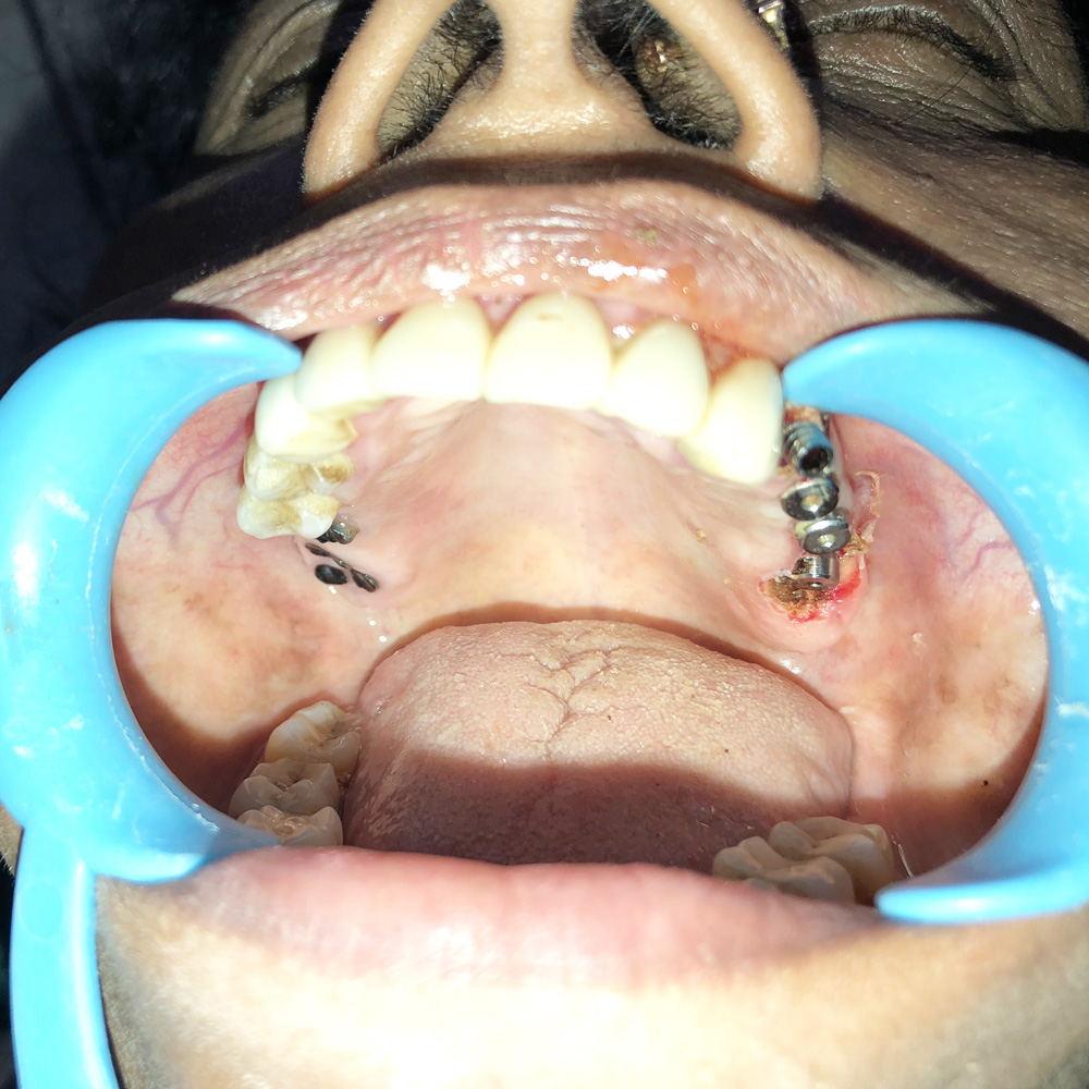 Full Arch&nbsp;Implants
