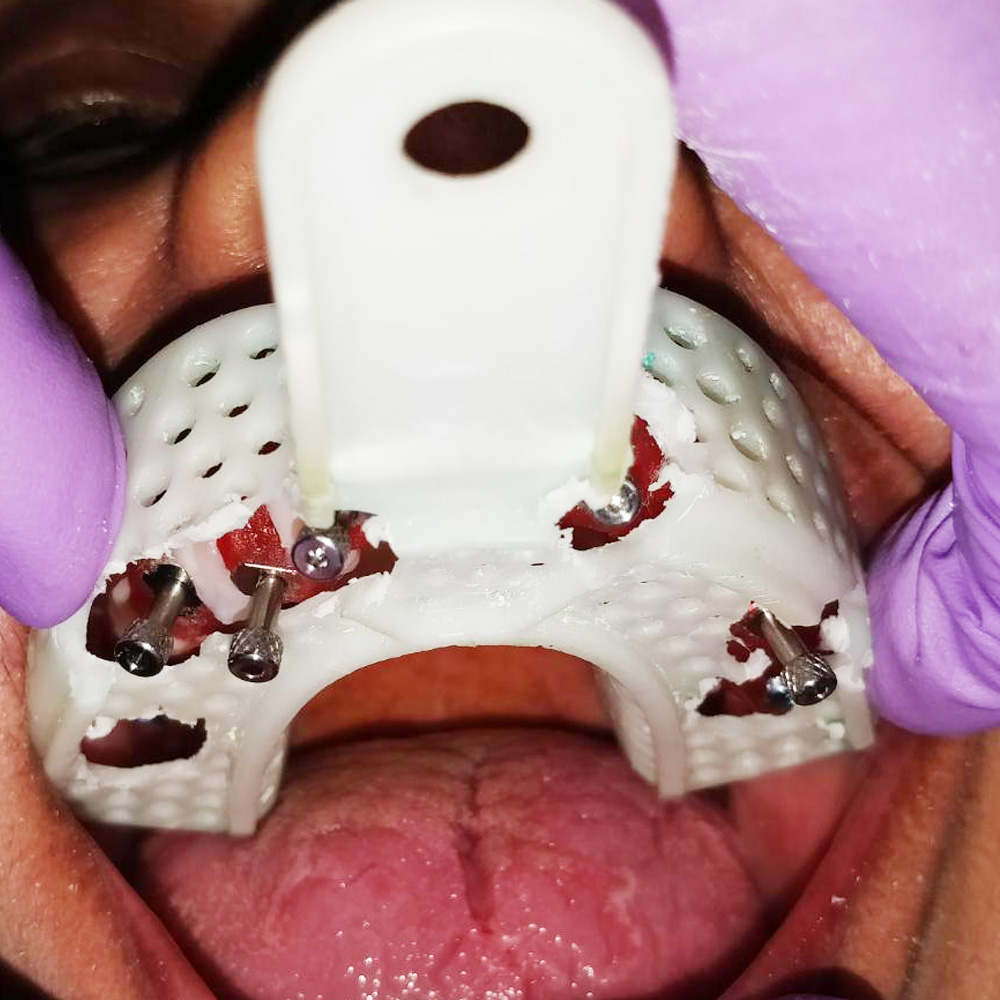 Implant Full Arch