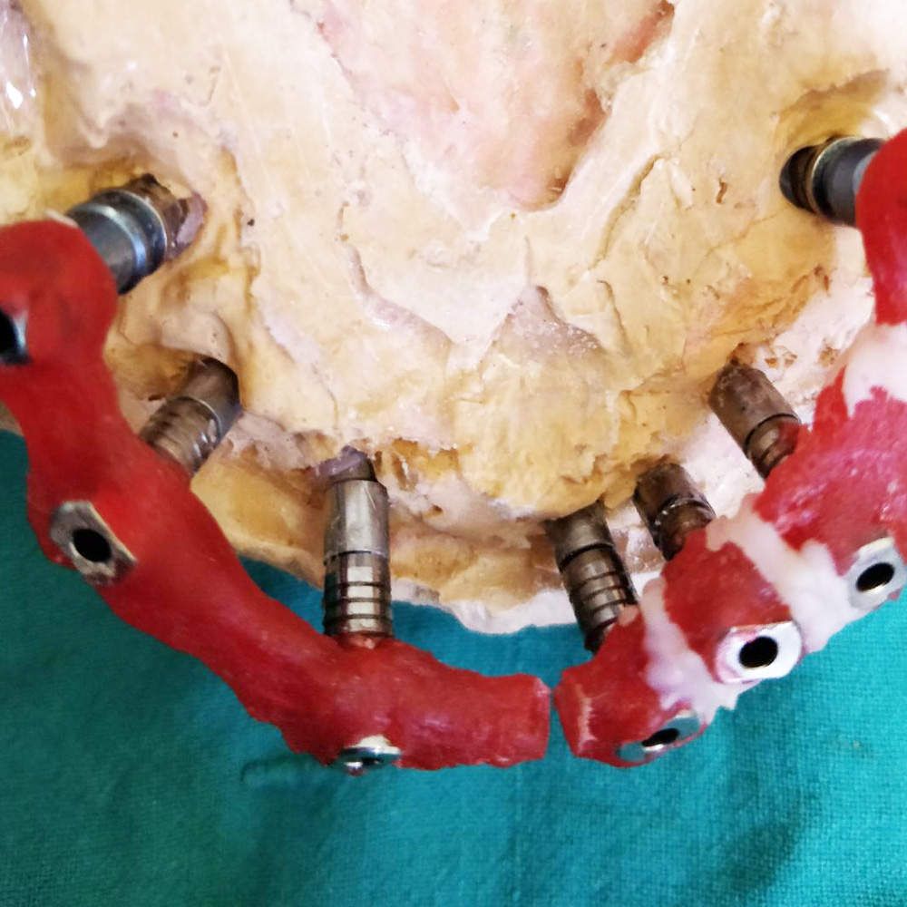 Implant Full Arch