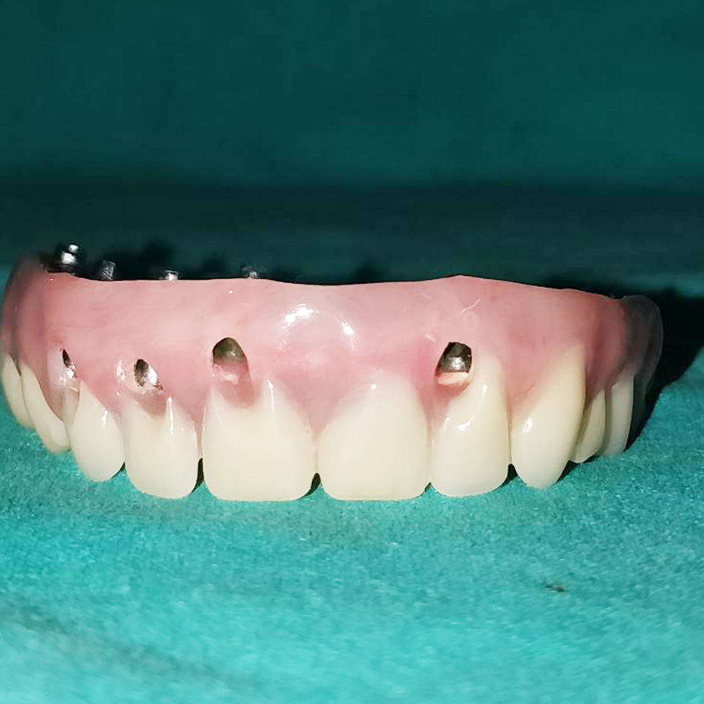 Implant Full Arch