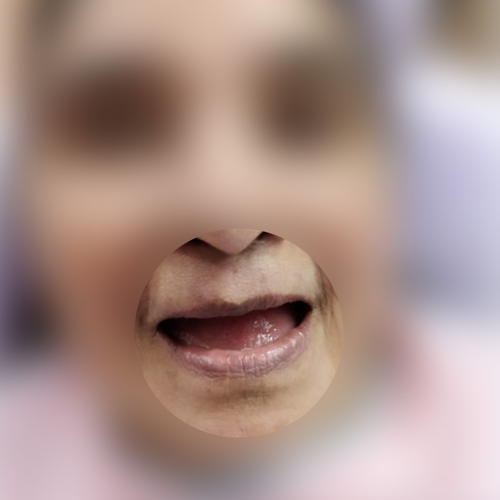 Implant Full Arch