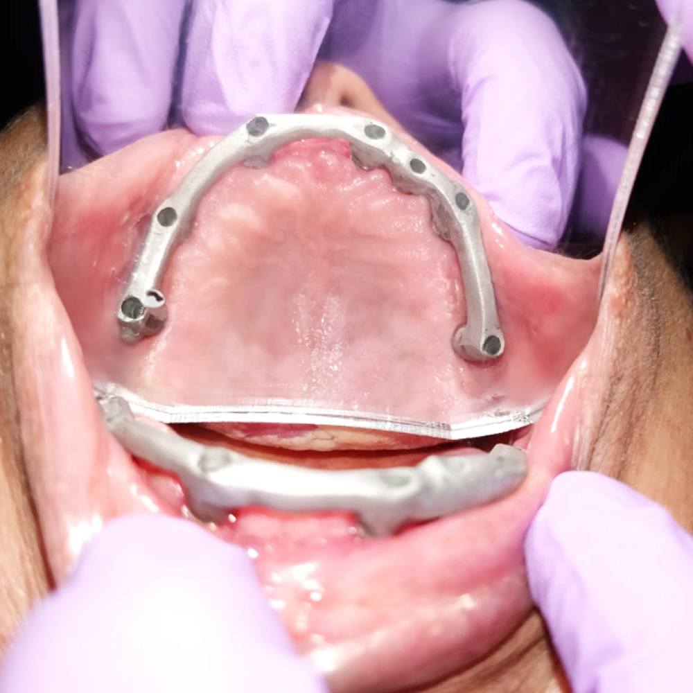 Implant Full Arch