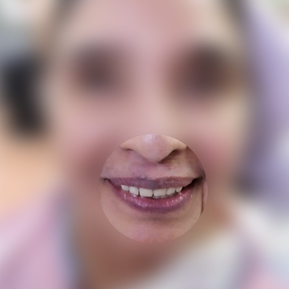 Implant Full Arch