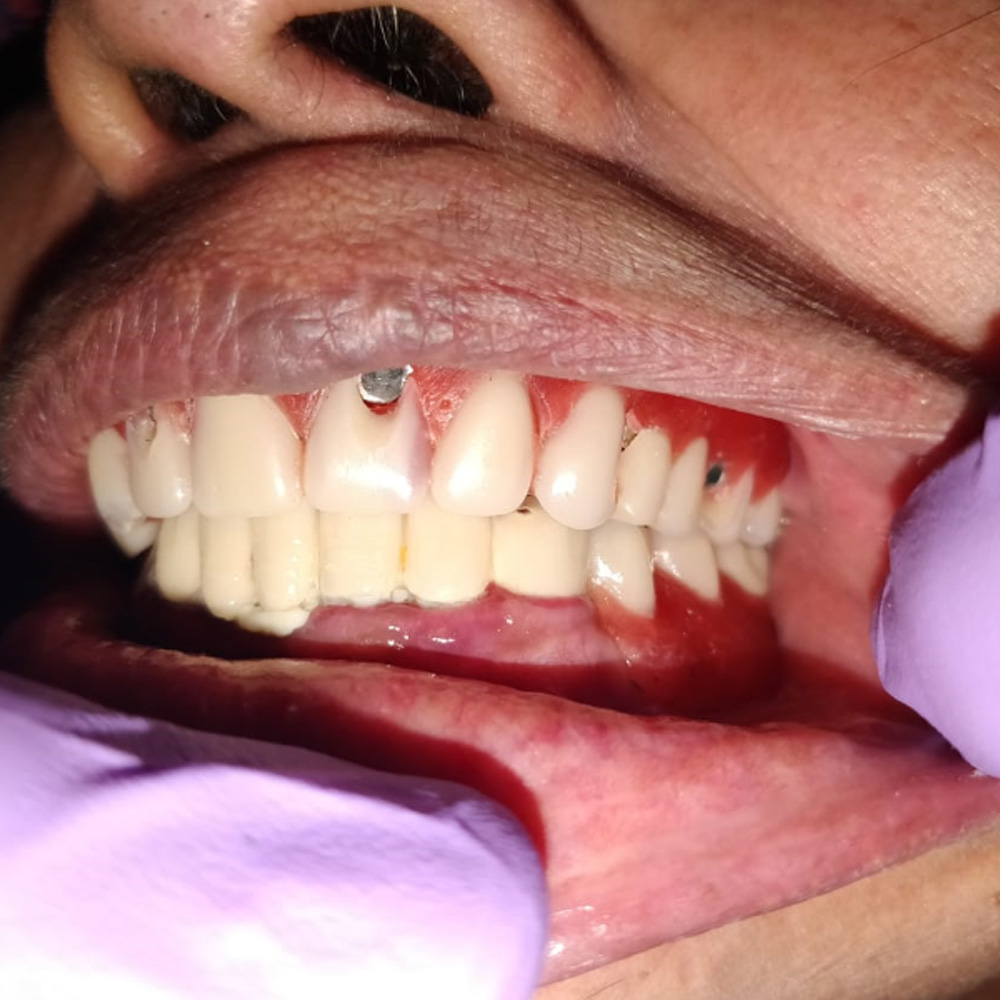 Implant Full Arch