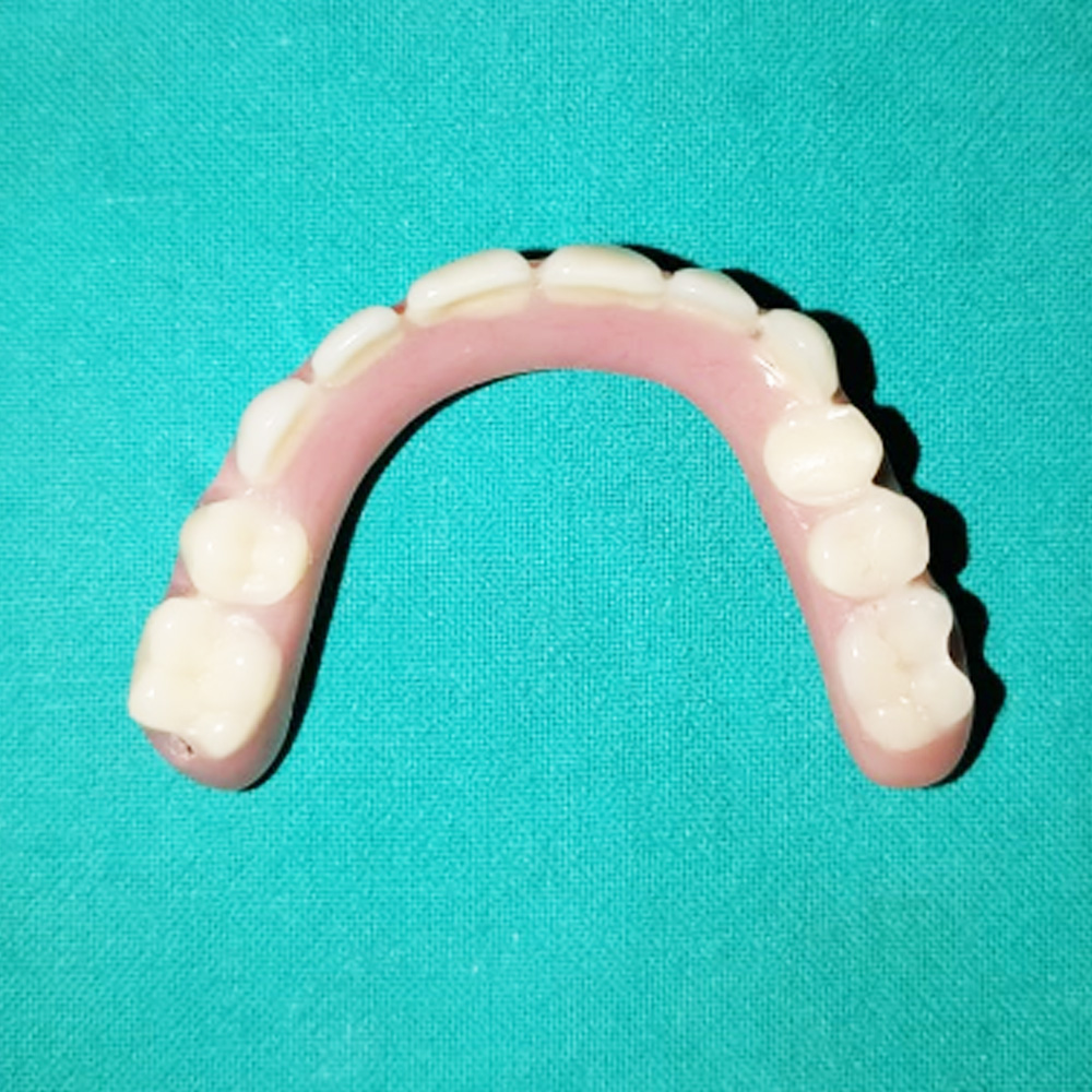 Implant Full Arch
