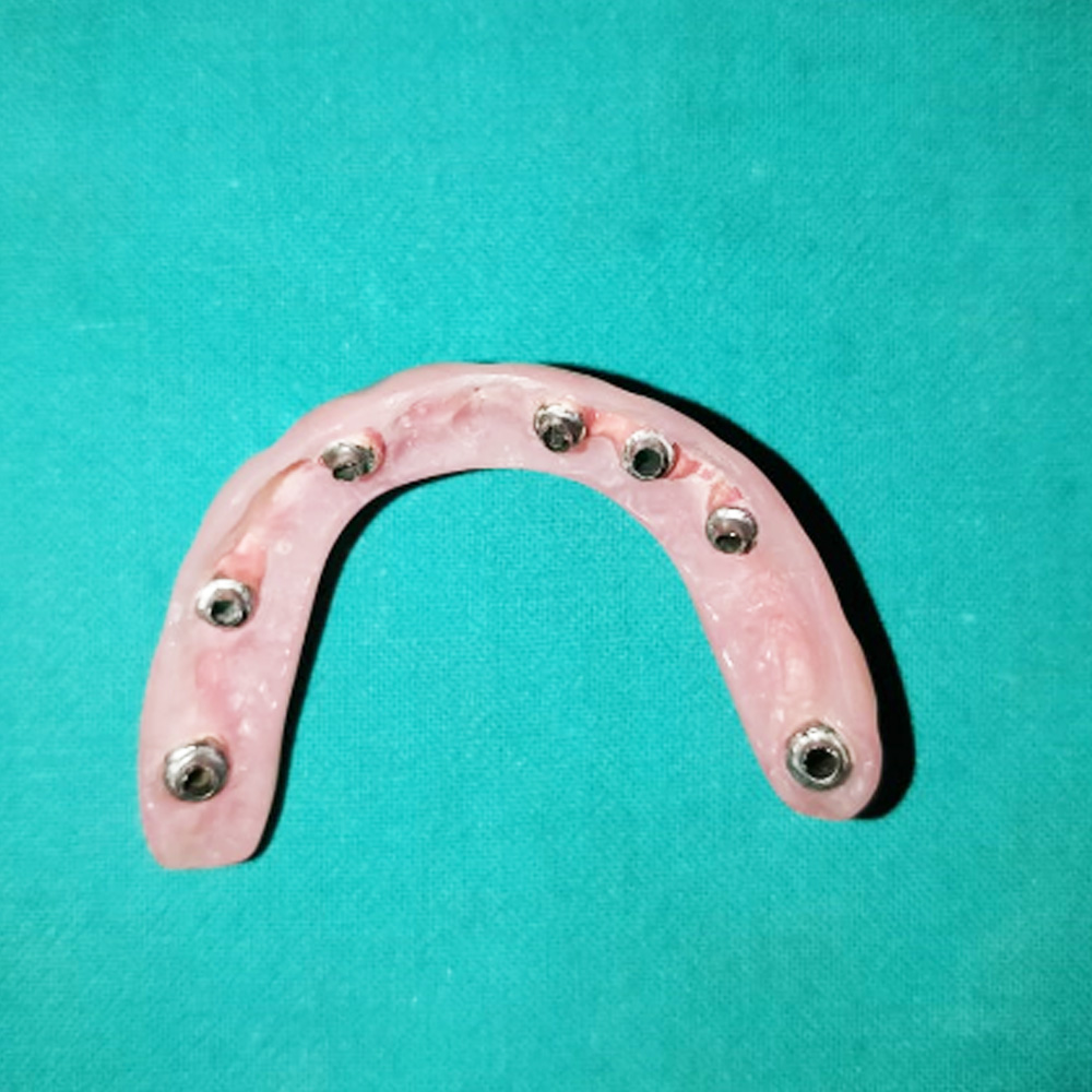 Implant Full Arch