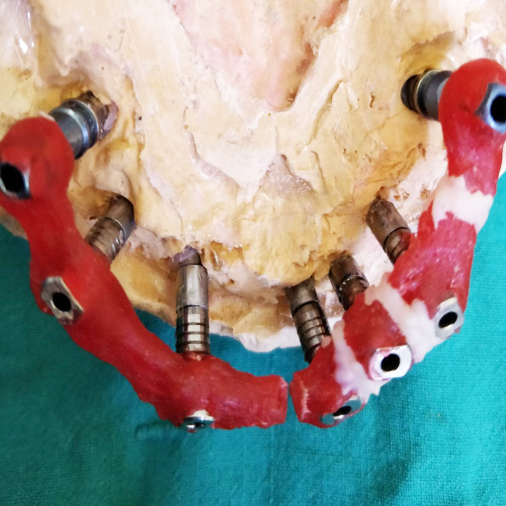 Implant Full Arch