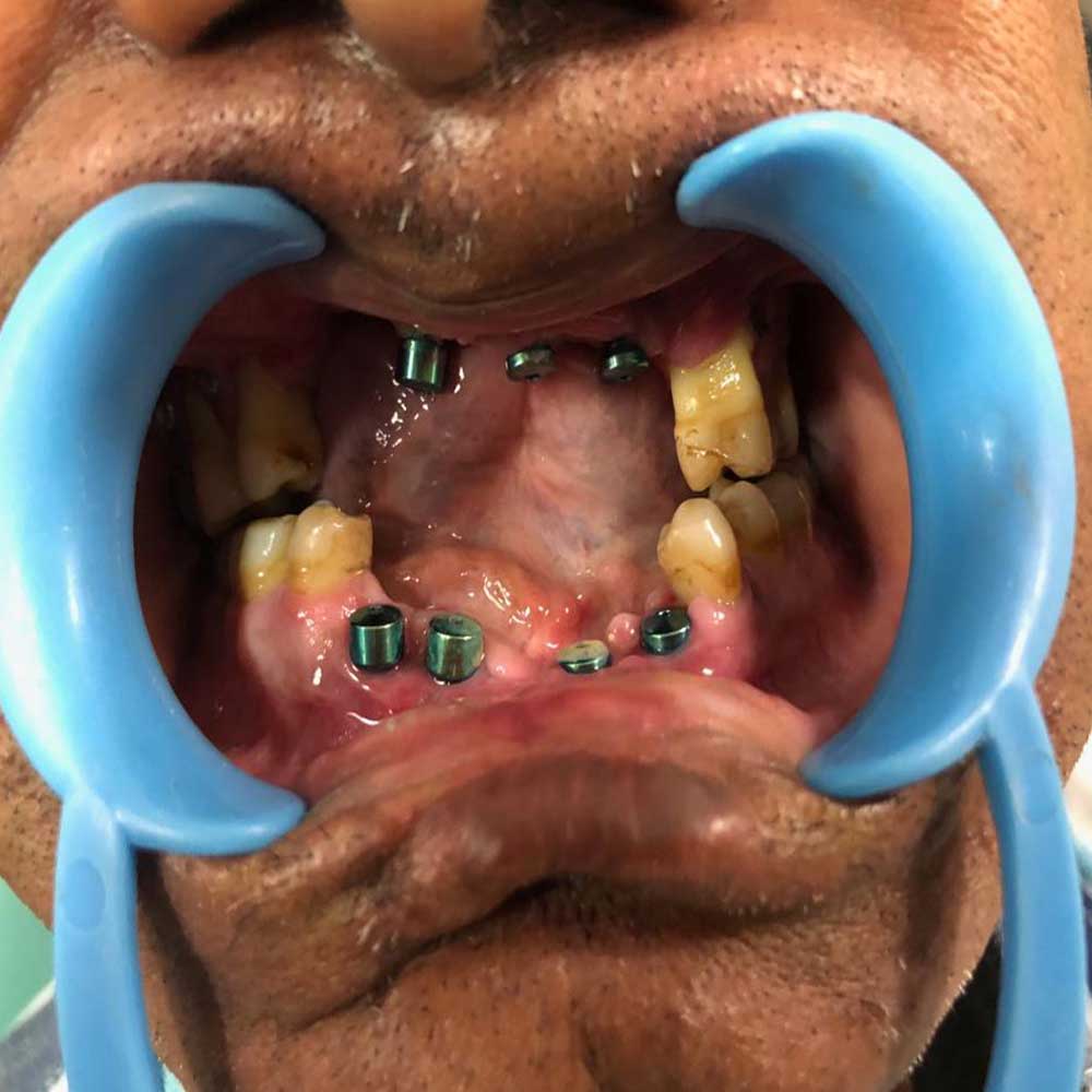 Dental Implants &amp; Trauma Plating