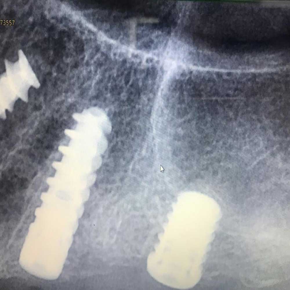 Ultra Short Implantology