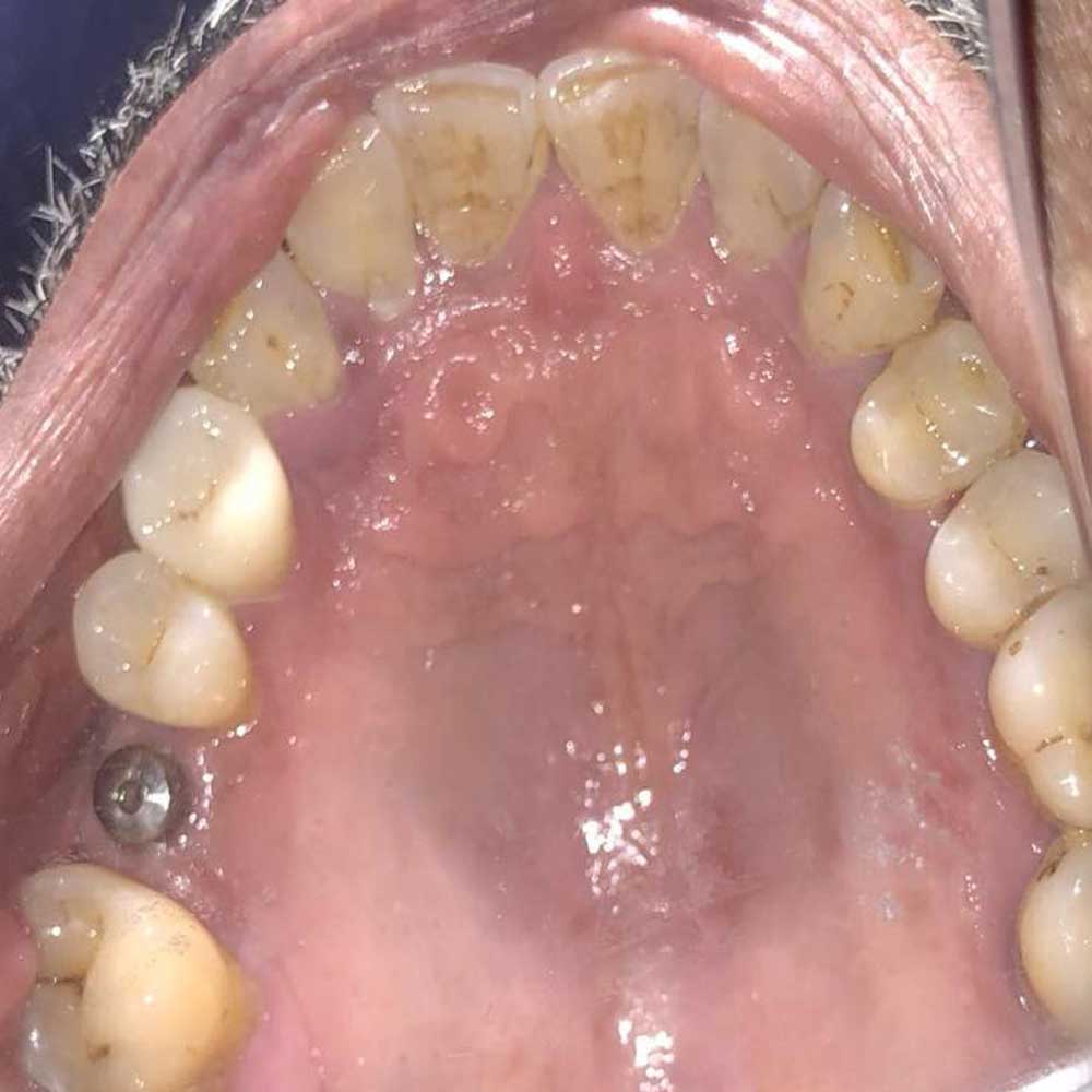 Dental Implants