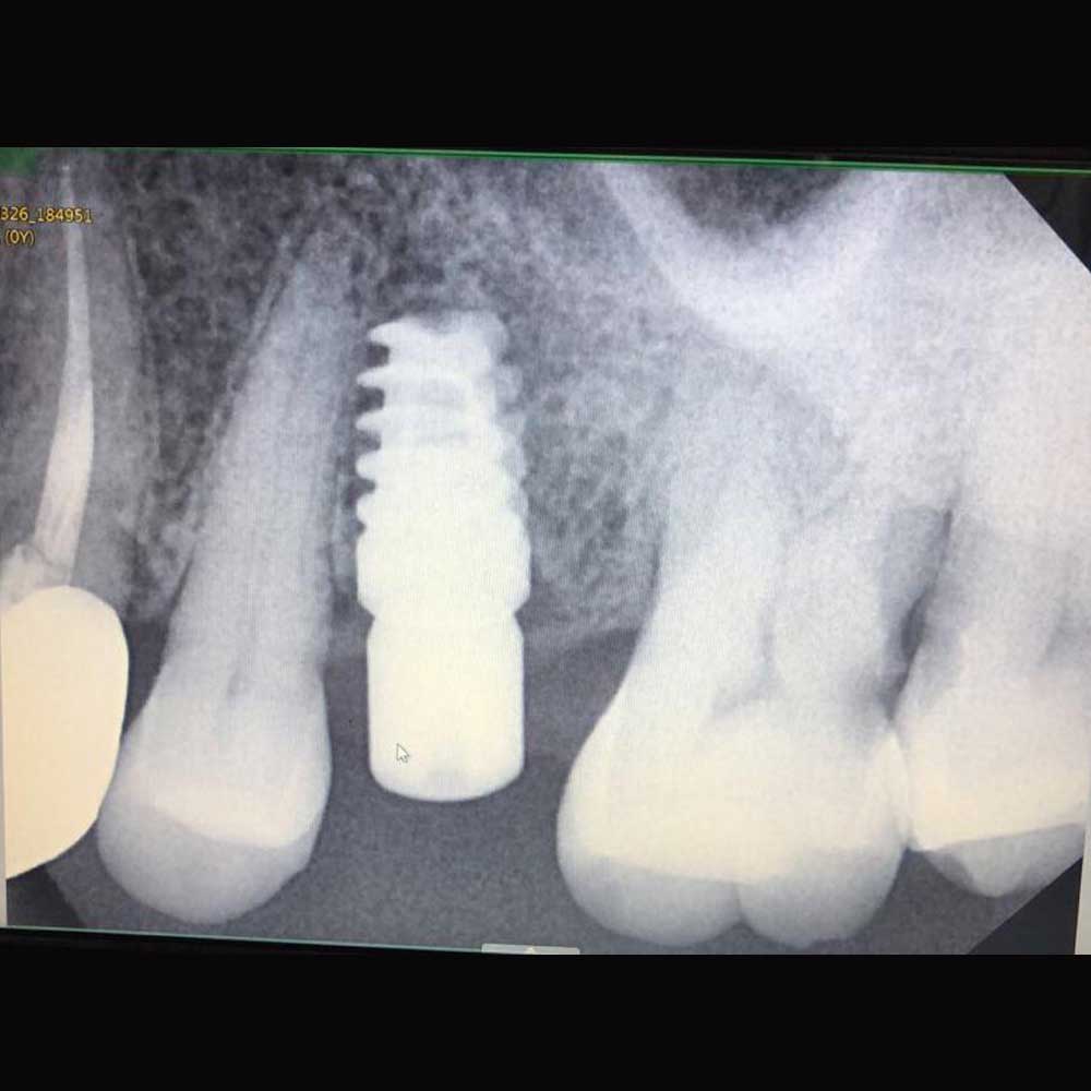 Dental Implants