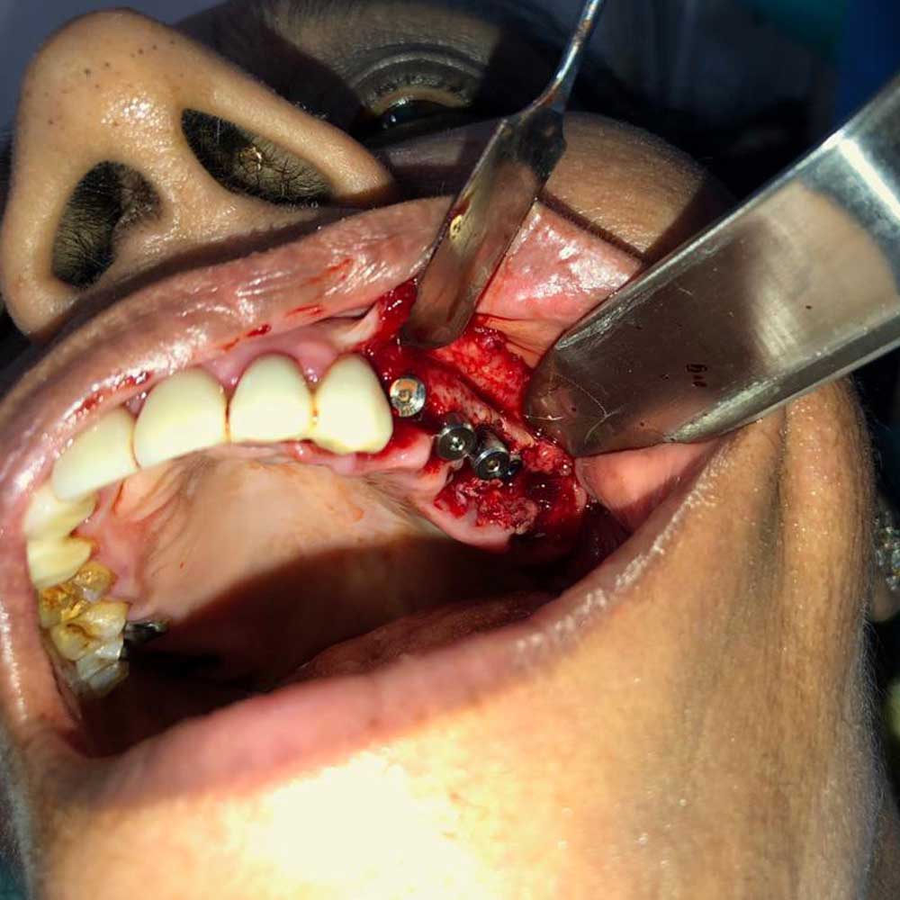 Immediate Implantology