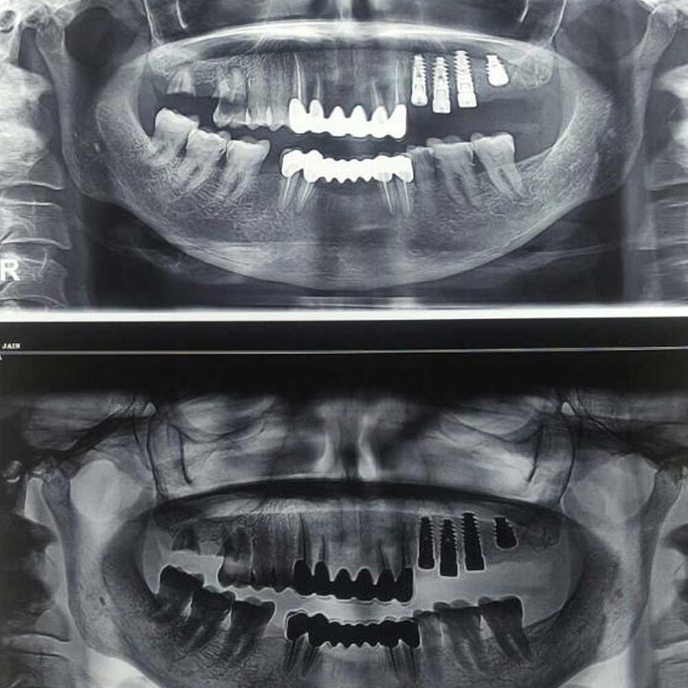 Immediate Implantology