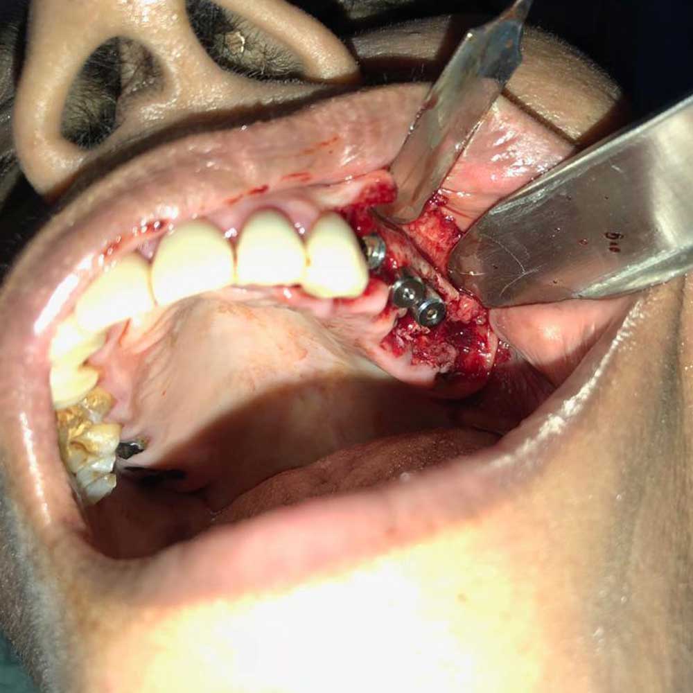 Immediate Implantology