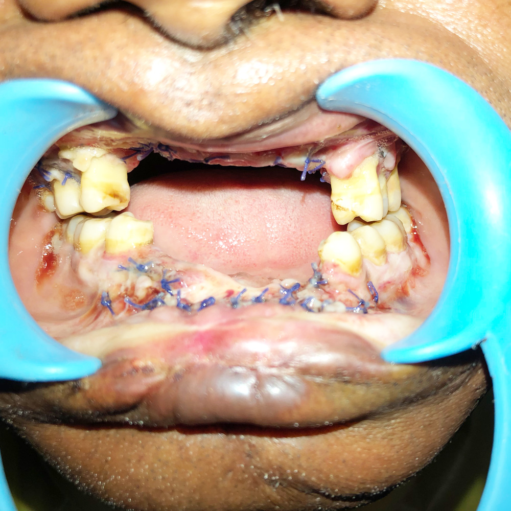 Dental Implants &amp; Trauma Plating