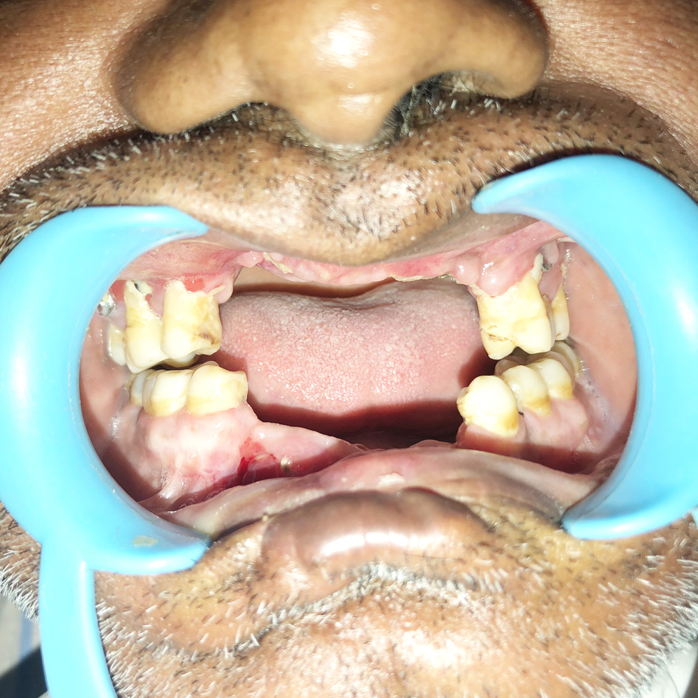 Dental Implants &amp; Trauma Plating