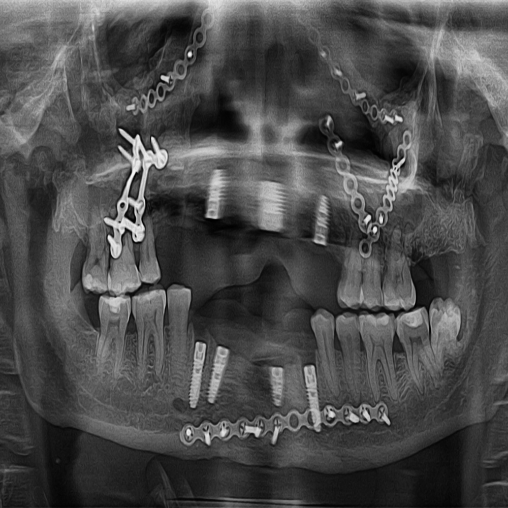 Dental Implants &amp; Trauma Plating