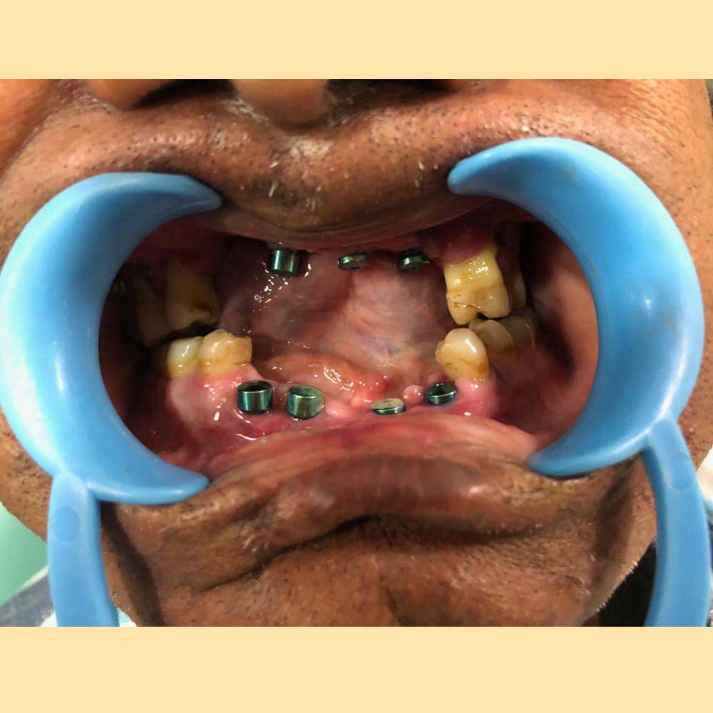 Dental Implants &amp; Trauma Plating