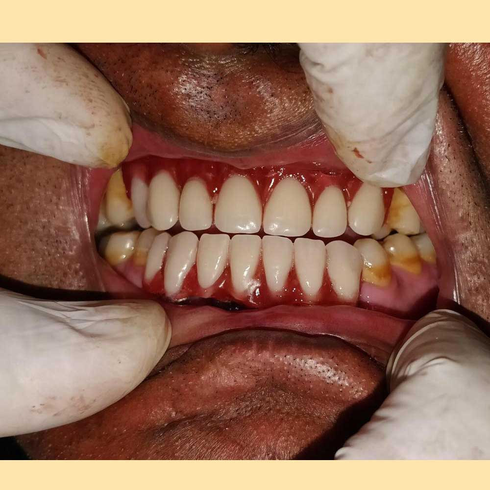 Dental Implants &amp; Trauma Plating
