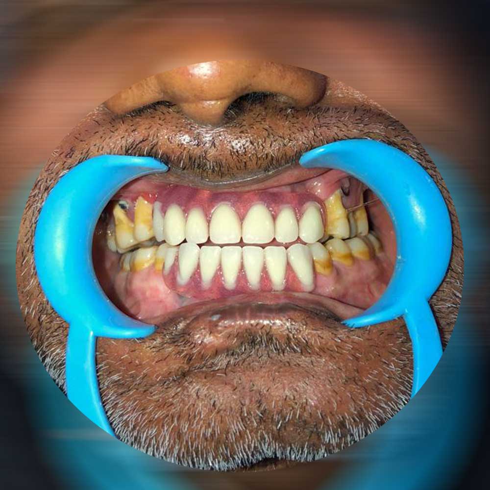 Dental Implants &amp; Trauma Plating