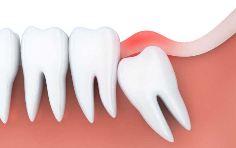Extractions / Wisdom Tooth Removal