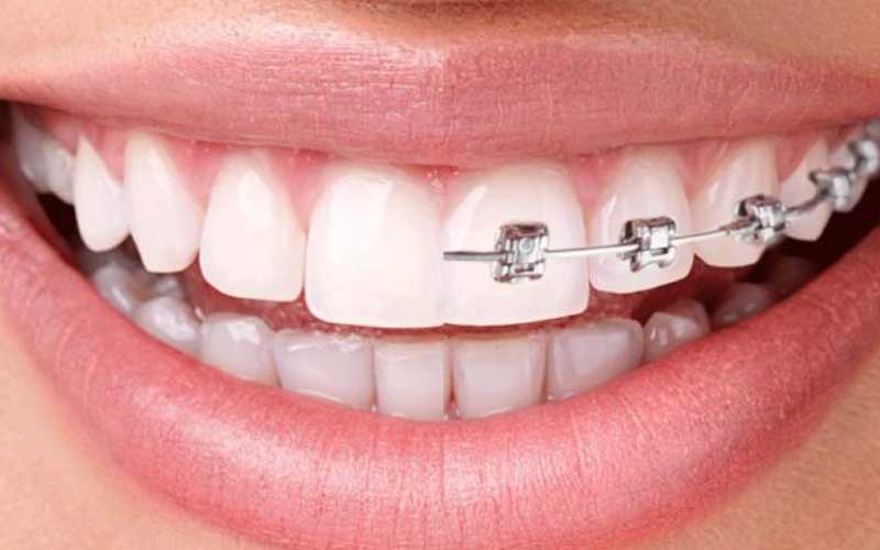 Orthodontic Treatment & Aligners / Invisalign