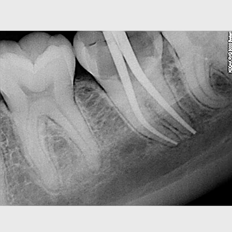 Root Canal Treatment