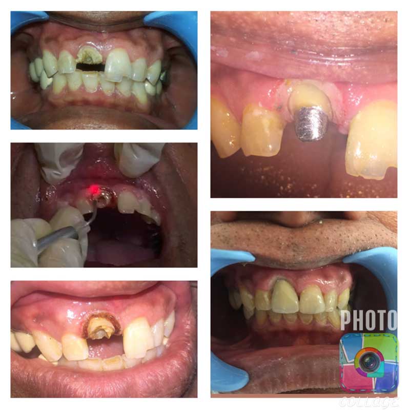 Laser Dentistry