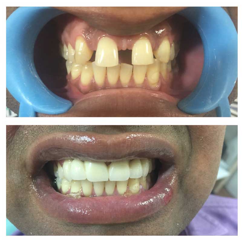 Cosmetic Filling